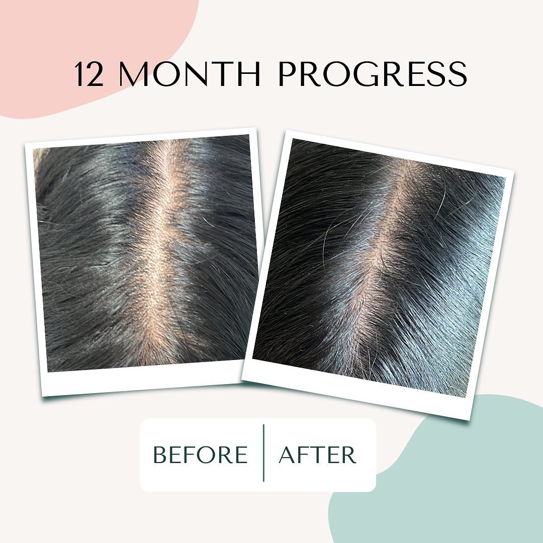 vancouver trichologist hair loss results